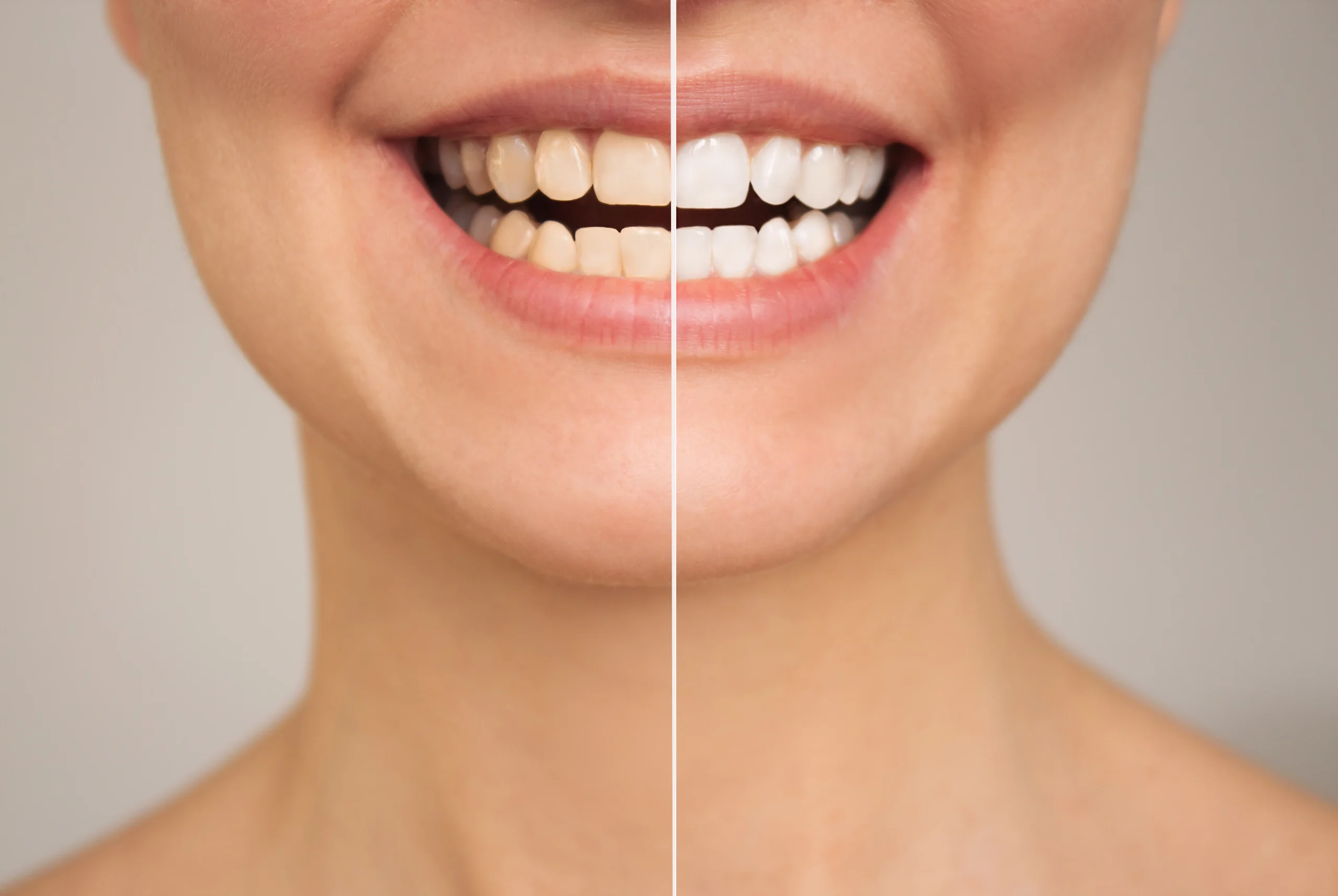 Teeth Whitening in Terre Haute