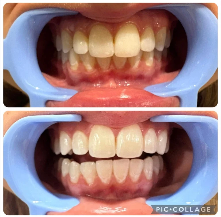 Terre Haute Teeth Whitening