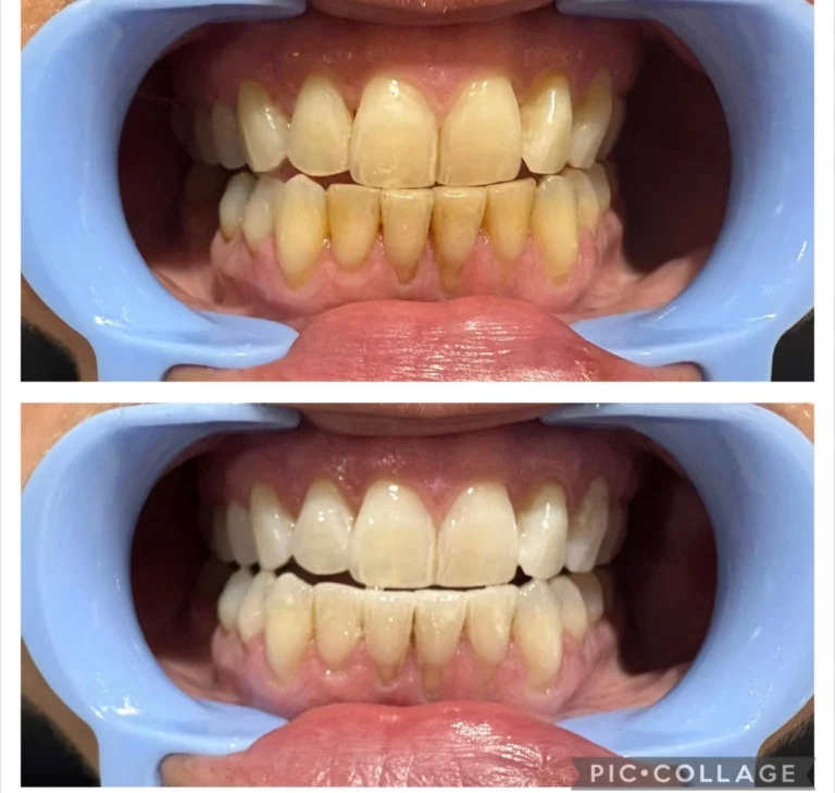Terre Haute Teeth Whitening