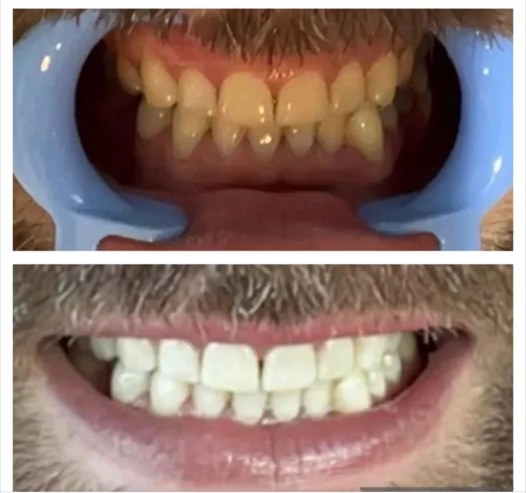 Terre Haute Teeth Whitening