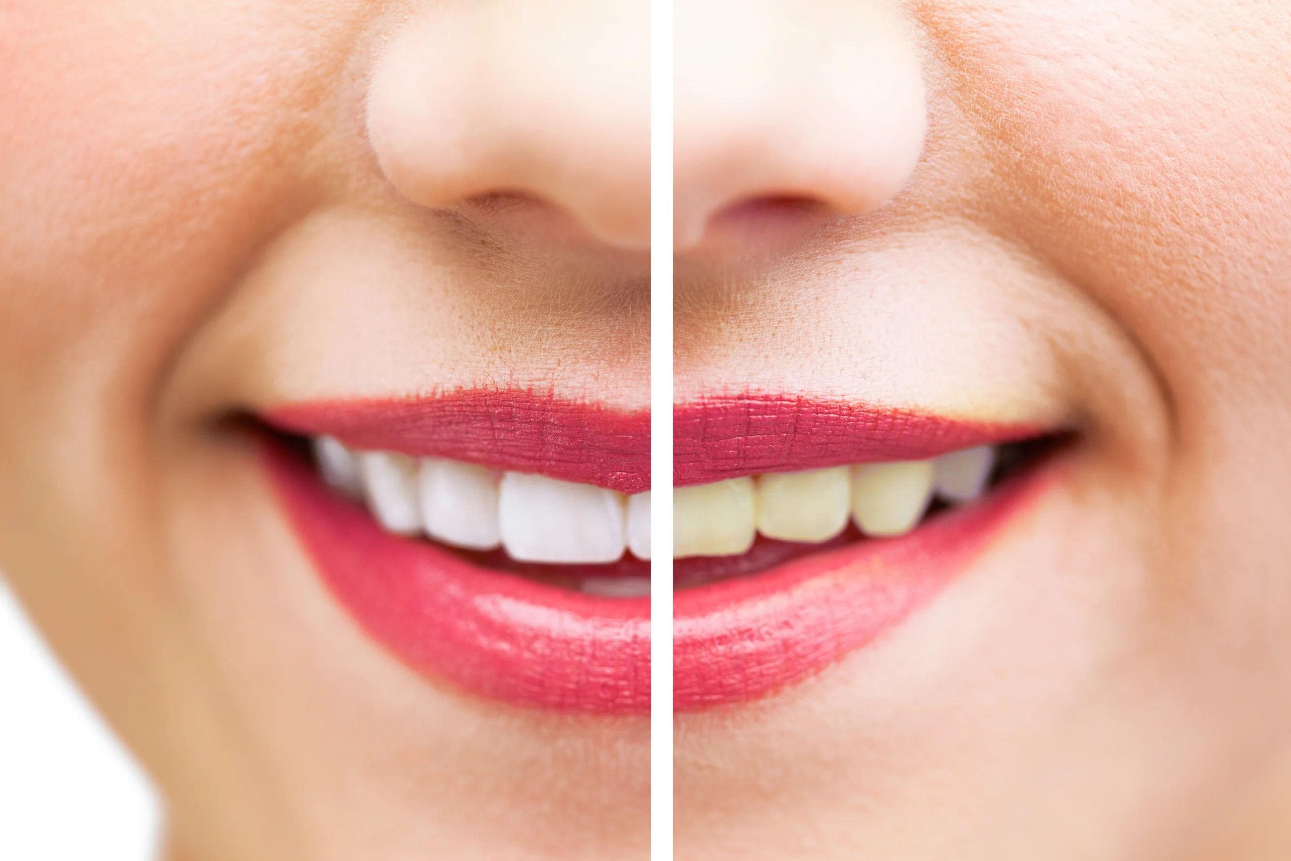 Teeth Whitening Terre Haute Cost